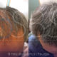Cura Alopecia Pistoia