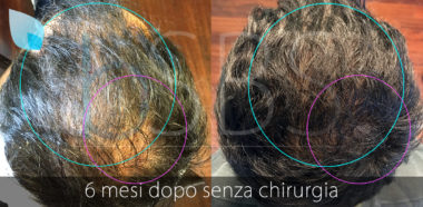 PRP Capelli Perugia