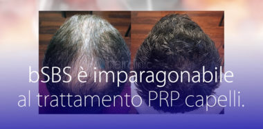 PRP Capelli Prima Dopo bSBS