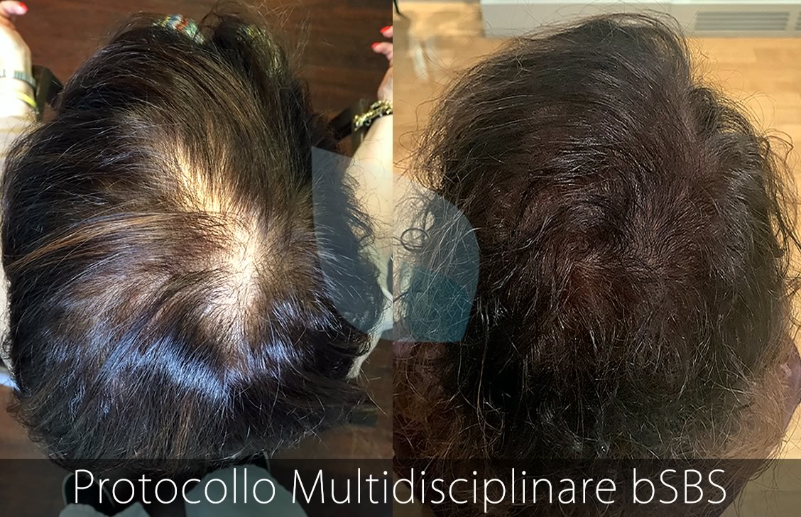 bSBS Capelli, PRP Capelli, Serenoa Repens