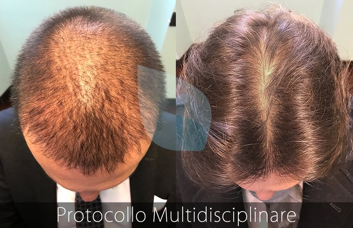 PRP Capelli Taranto II