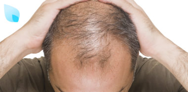 Alopecia Cause e Cure