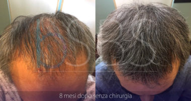 Cura Alopecia Pistoia