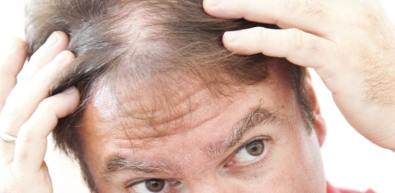 Depressione Causa Alopecia