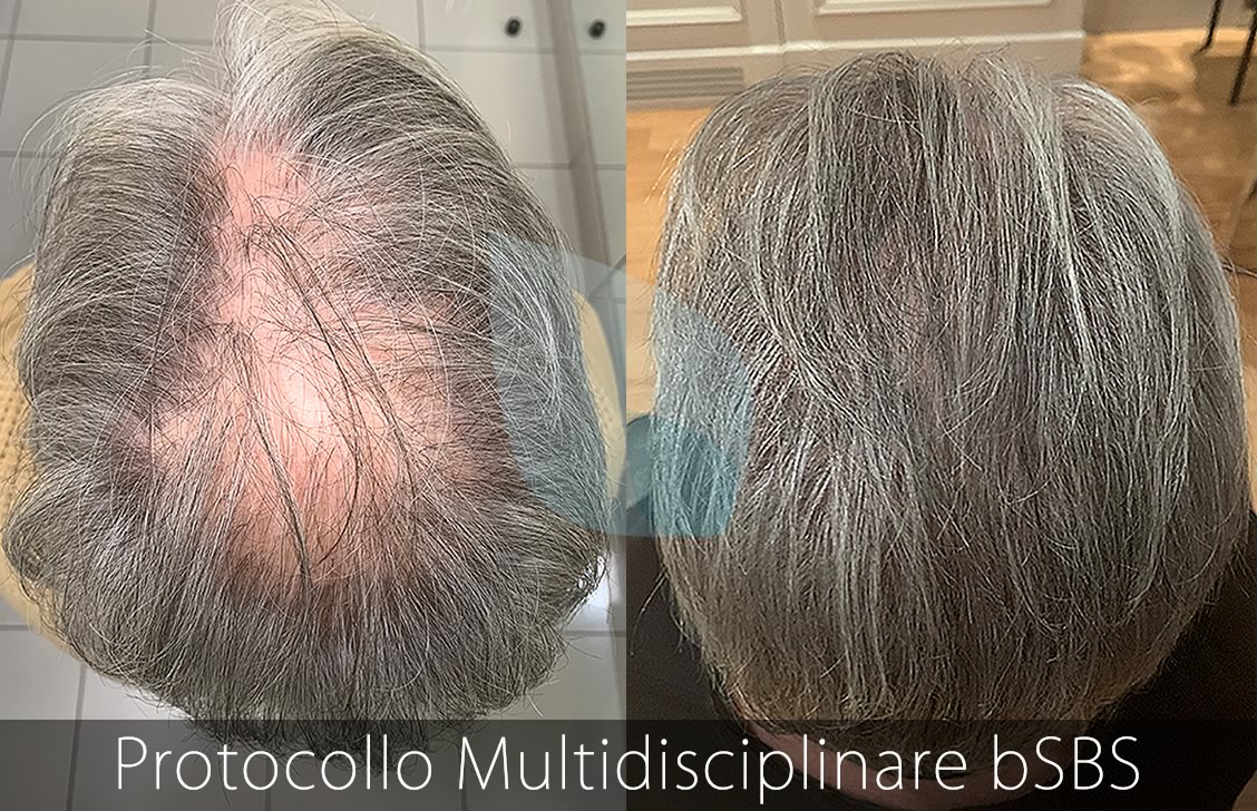 bSBS Capelli, PRP Capelli, hCRP Capelli, Calvizie e nuove cure