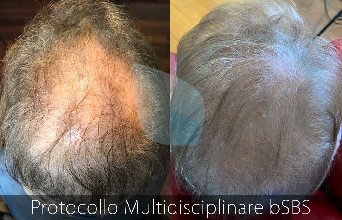 bSBS Capelli, PRP Capelli, hCRP Capelli, Calvizie da Stress