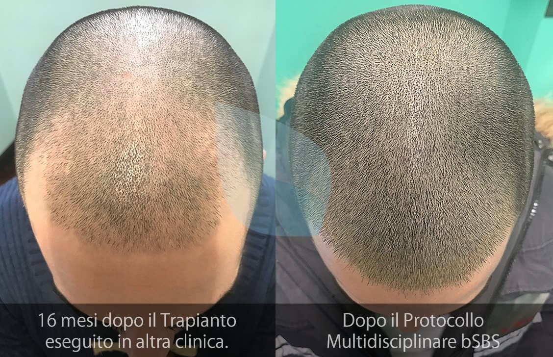 bSBS Capelli, PRP Capelli, hCRP Capelli, Fibroblasti e ricrescita dei capelli