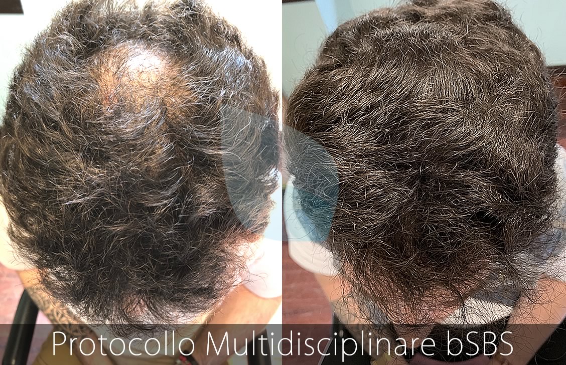 bSBS Capelli, PRP Capelli, hCRP Capelli, Minoxidil Solfato