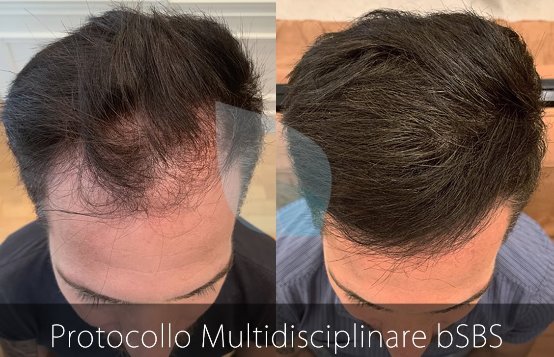 Alopecia e Genetica, La Caduta di Capelli si può curare, Calvizie e Cellule Staminali