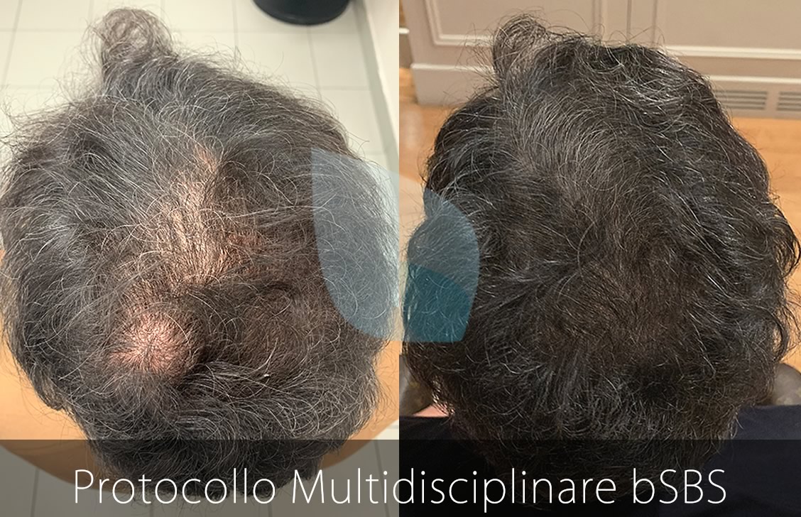 bSBS Capelli, PRP Capelli, hCRP Capelli, Trapianto Capelli non cura
