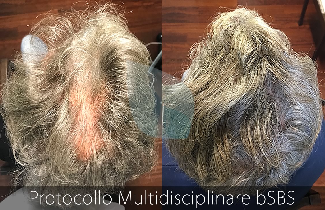 bSBS Capelli, PRP Capelli, hCRP Capelli, Calvizie, Deressione e Alopecia