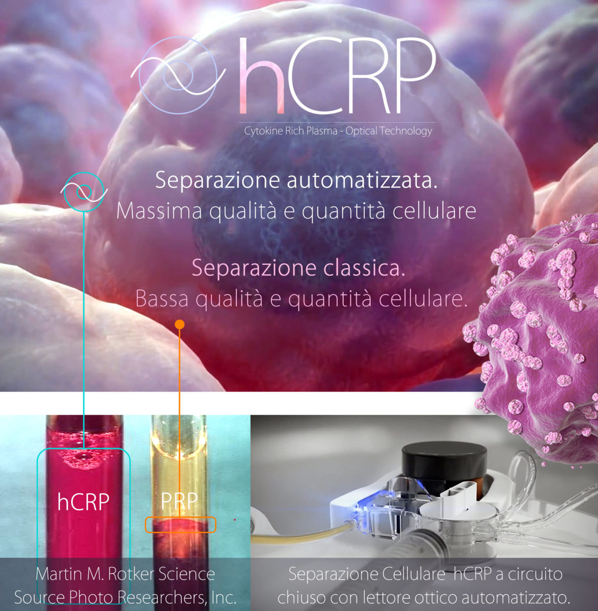 hCRP Capelli, bSBS Capelli, PRP Capelli, Trapianto Capelli Napoli