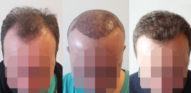 Autotrapianto Capelli Latina atFUE