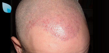 Cura Dermatite Seborroica