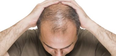 Soluzione Alopecia Androgenetica