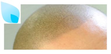 Tricopigmentazione ed Alopecia
